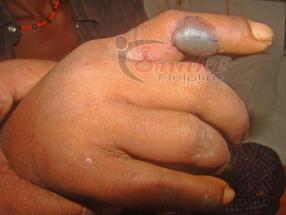 blister