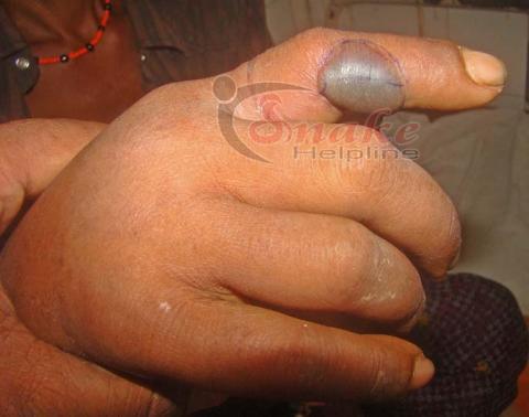 blister